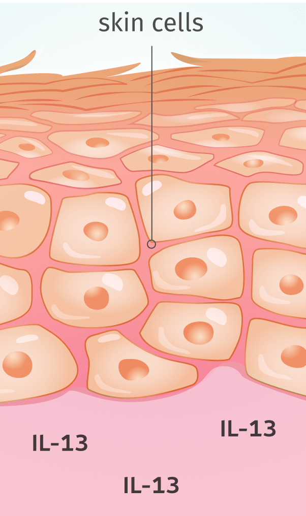 Adbry® (tralokinumab-ldrm) treated skin with the skins cells and lowered IL-13.