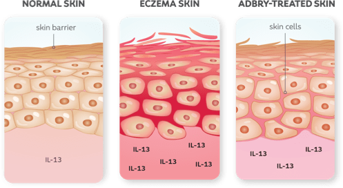 Three images comparing normal skin, skin inflamed with eczema, and eczema inflamed skin after being treated by Adbry™ (tralokinumab- ldrm)