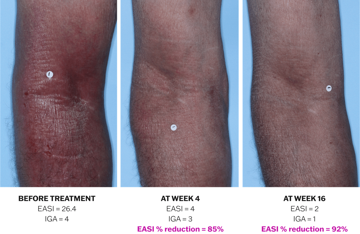 Progression of atopic dermatitis treatment on an arm using Adbry® monotherapy, showing results before treatment, at Week 4, and at Week 16.