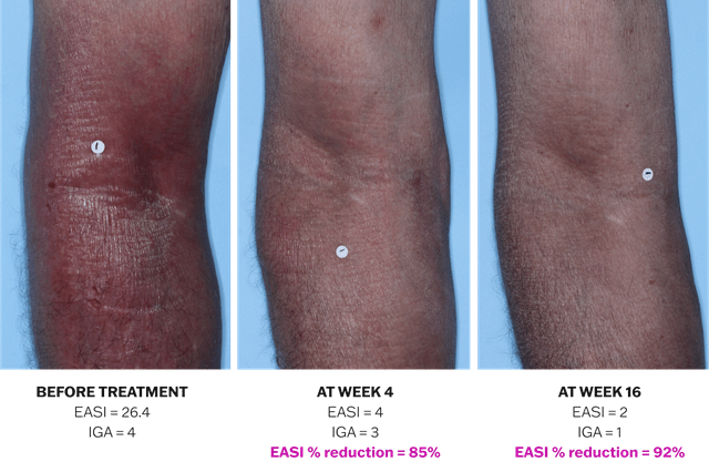 Progression of atopic dermatitis treatment on an arm using Adbry® monotherapy, showing results before treatment, at Week 4, and at Week 16.