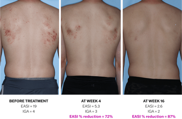 Progression of atopic dermatitis treatment on a back using Adbry® monotherapy, showing results before treatment, at Week 4, and at Week 16.