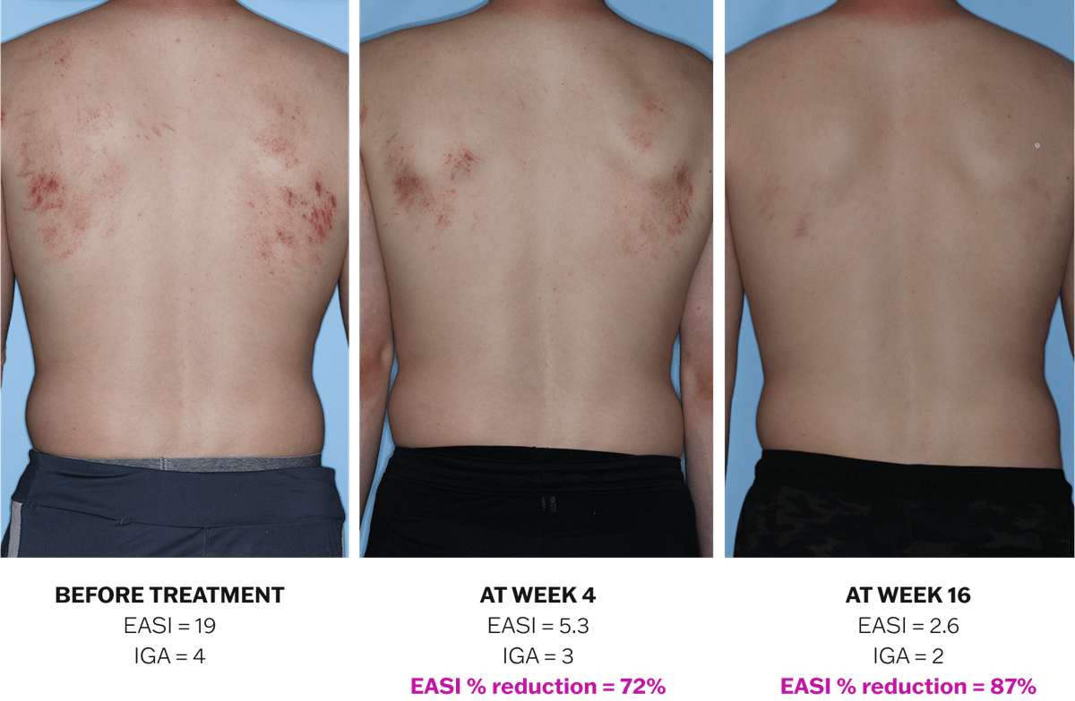 Progression of atopic dermatitis treatment on a back using Adbry® monotherapy, showing results before treatment, at Week 4, and at Week 16.