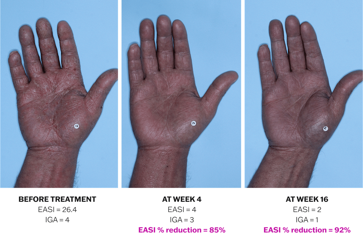 Progression of atopic dermatitis treatment on a hand using Adbry® monotherapy, showing results before treatment, at Week 4, and at Week 16.