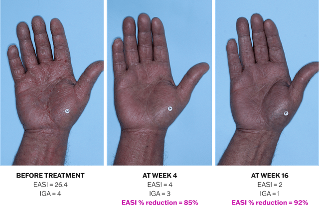 Progression of atopic dermatitis treatment on a hand using Adbry® monotherapy, showing results before treatment, at Week 4, and at Week 16.