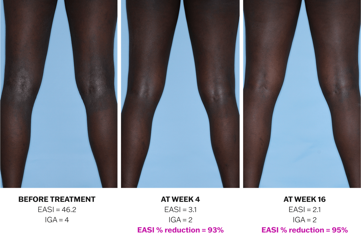 Progression of atopic dermatitis treatment on legs using Adbry® monotherapy, showing results before treatment, at Week 4, and at Week 16.