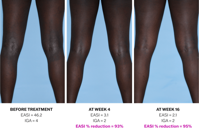 Progression of atopic dermatitis treatment on legs using Adbry® monotherapy, showing results before treatment, at Week 4, and at Week 16.