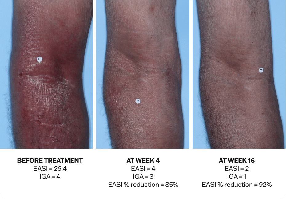 Progression of atopic dermatitis treatment on an arm using Adbry® monotherapy, showing results before treatment, at Week 4, and at Week 16.