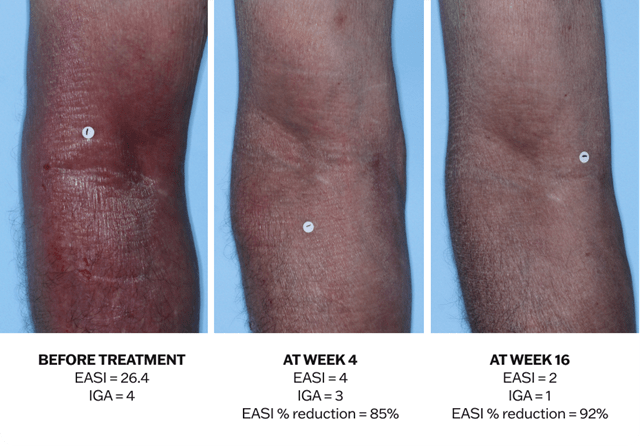 Progression of atopic dermatitis treatment on an arm using Adbry® monotherapy, showing results before treatment, at Week 4, and at Week 16.