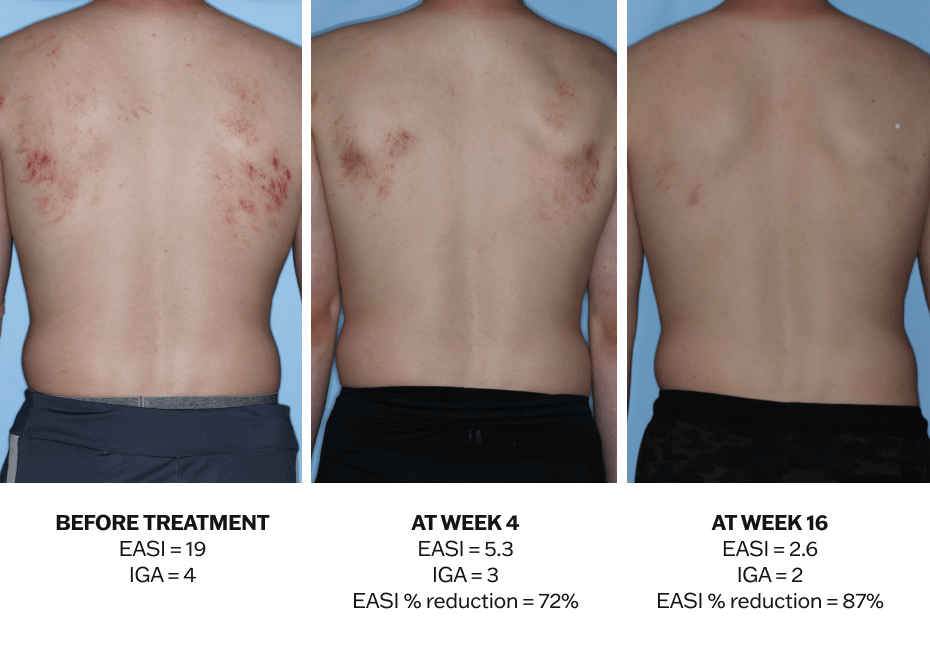 Progression of atopic dermatitis treatment on a back using Adbry® monotherapy, showing results before treatment, at Week 4, and at Week 16.