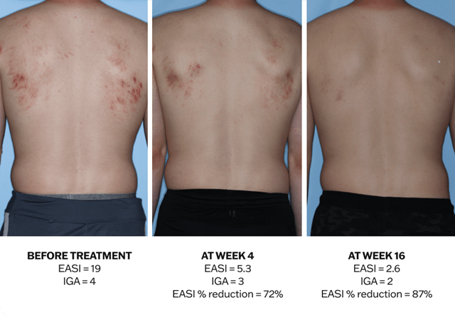 Progression of atopic dermatitis treatment on a back using Adbry® monotherapy, showing results before treatment, at Week 4, and at Week 16.