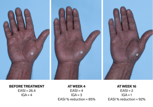 Progression of atopic dermatitis treatment on a hand using Adbry® monotherapy, showing results before treatment, at Week 4, and at Week 16.