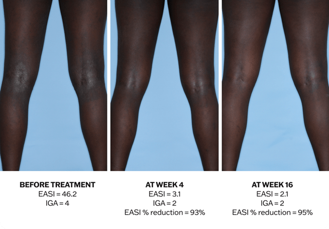 Progression of atopic dermatitis treatment on legs using Adbry® monotherapy, showing results before treatment, at Week 4, and at Week 16.