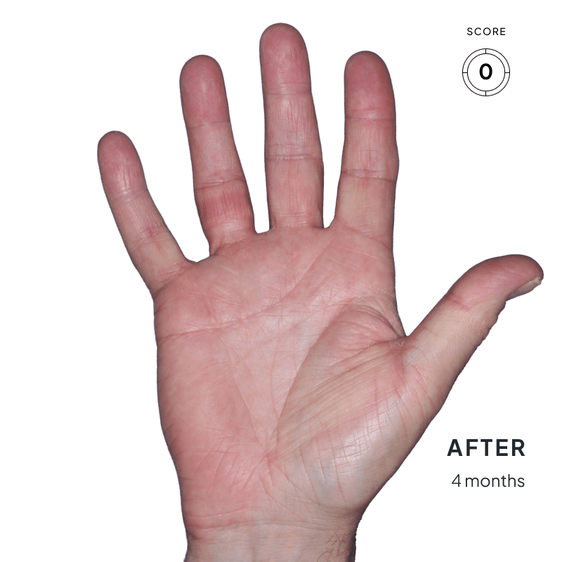 Before-and-after image of a hand showing skin improvement after 4 months of Anzupgo® treatment