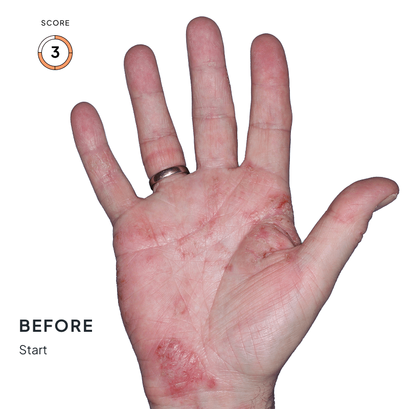 Before-and-after image of a hand showing skin improvement after 4 months of Anzupgo® treatment