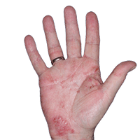 Small thumbnail of hand showing redness and irritation before Anzupgo® treatment