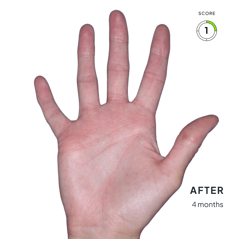 Before-and-after image of chronic hand eczema showing improvement from score 4 to 1 after 4 months of Anzupgo® treatment