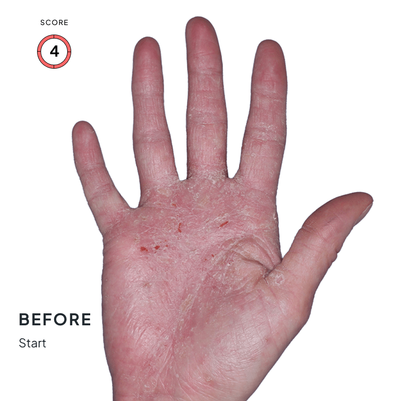 Before-and-after image of chronic hand eczema showing improvement from score 4 to 1 after 4 months of Anzupgo® treatment