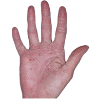 Small thumbnail of hand showing irritation before Anzupgo® treatment