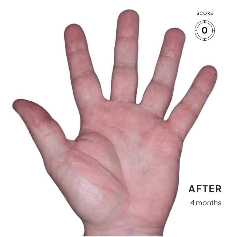 Before-and-after image of chronic hand eczema showing improvement from score 4 to 0 after 4 months of Anzupgo® treatment