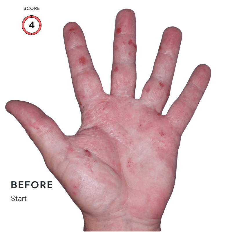 Before-and-after image of chronic hand eczema showing improvement from score 4 to 0 after 4 months of Anzupgo® treatment