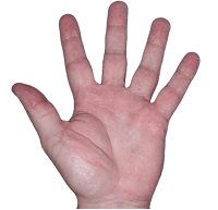 Small thumbnail of hand showing redness and cracked skin before Anzupgo® treatment
