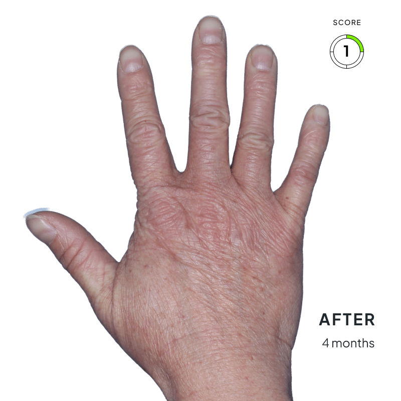 Before and after image showing improved skin texture and reduced inflammation after 4 months of Anzupgo® use