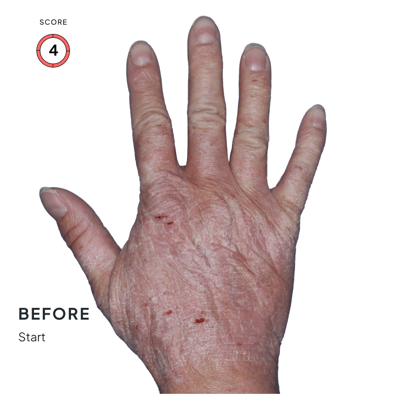 Before and after image showing improved skin texture and reduced inflammation after 4 months of Anzupgo® use