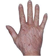 Small thumbnail of hand with inflamed, scaly skin before Anzupgo® treatment