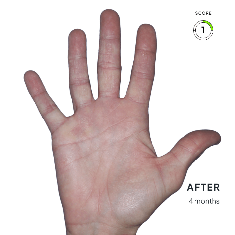 Before-and-after comparison showing chronic hand eczema improvement from score 3 to score 1 after 4 months of Anzupgo® treatment