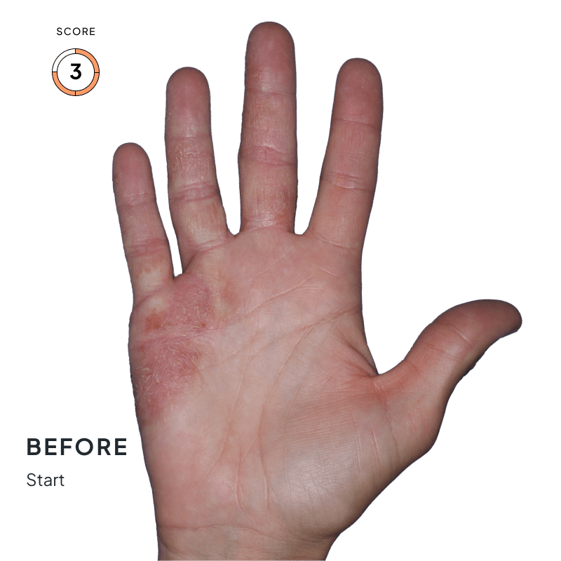 Before-and-after comparison showing chronic hand eczema improvement from score 3 to score 1 after 4 months of Anzupgo® treatment