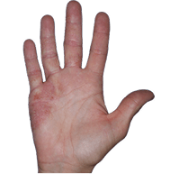Hand showing chronic eczema with visible inflammation and scaling on palm and fingers