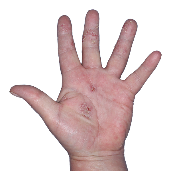 Case 1: At Baseline, patient has erythema, scaling, and erosions. IGA-CHE score: 4. HESD-Itch score: 5.9. HESD-Pain score: 5.9