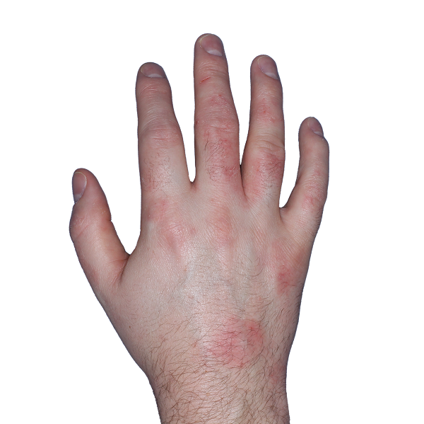 Case 2: At Baseline, patient has erythema and vesicles. IGA-CHE score: 3. HESD-Itch score: 6.9. HESD-Pain score: 7.1