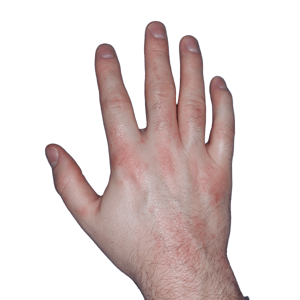 Case 2, Week 4: IGA-CHE score: 3. HESD-Itch score: 3.3. HESD-Pain score: 3.3