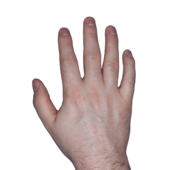 Case 2, Week 8: IGA-CHE score: 1. HESD-Itch score: 2.2. HESD-Pain score: 1.5