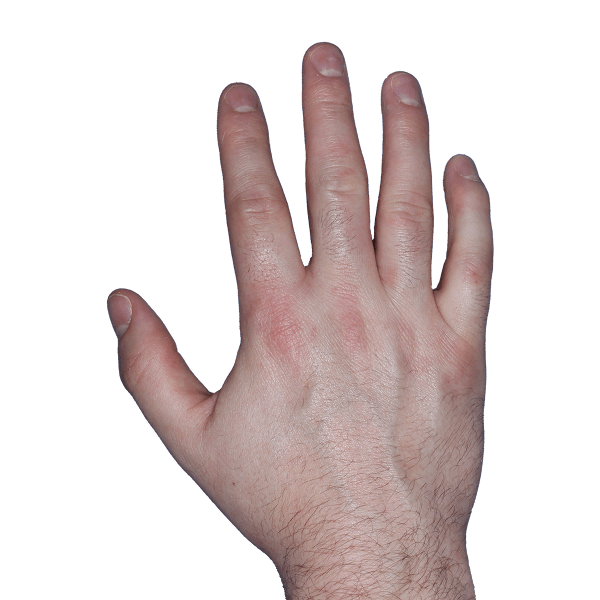 Case 2, Week 16: IGA-CHE score: 1. HESD-Itch score: 1.3. HESD-Pain score: 1.6