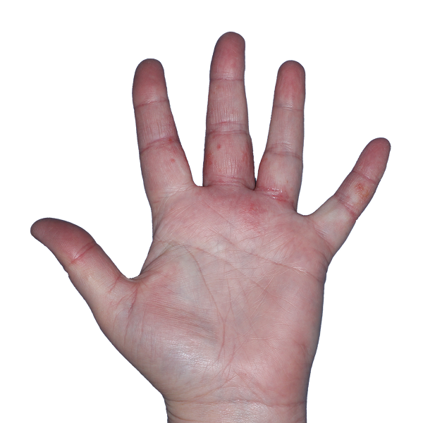 Case 3: At Baseline, patient has vesicles, erythema, and erosions. IGA-CHE score: 4. HESD-Itch score: 8. HESD-Pain score: 7.6.