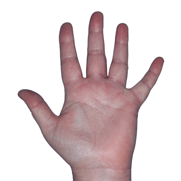 Case 3, Week 8: IGA-CHE score: 1. HESD-Itch score: 0.9. HESD-Pain score: 2.9