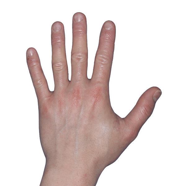 Case 4: At Baseline, patient has erythema and vesicles. IGA-CHE score: 4. HESD-Itch score: 6.7. HESD-Pain score: 6.7