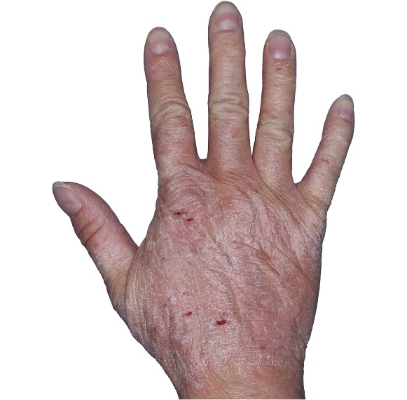 Case 1: At Baseline, patient has scaling, cracks, and fissures. IGA-CHE score: 4. HESD-Itch score: 6. HESD-Pain score: 6.4