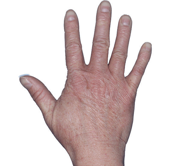 Case 1, Week 16: iGA-CHE score: 1. HESD-Itch score: 0. HESD-Pain score: 0