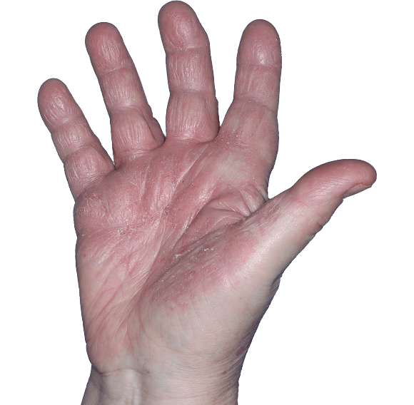 Case 2: At Baseline, patient has scaling and erythema. iGA-CHE score: 4. HESD-Itch score: 5.1. HESD-Pain score: 4.7