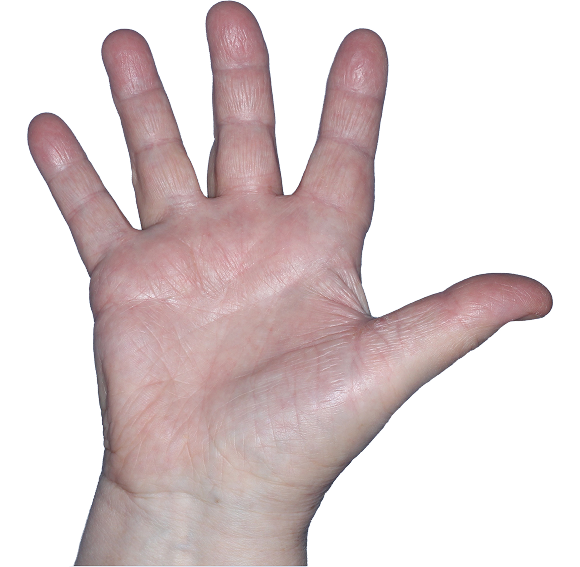 Case 2, Week 4: IGA-CHE score: 1. HESD-Itch score: 1.4. HESD-Pain score: 0.7