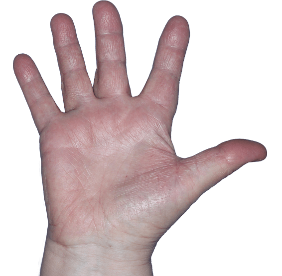 Case 2, Week 8: IGA-CHE score: 1. HESD-Itch score: 0.7. HESD-Pain score: 0