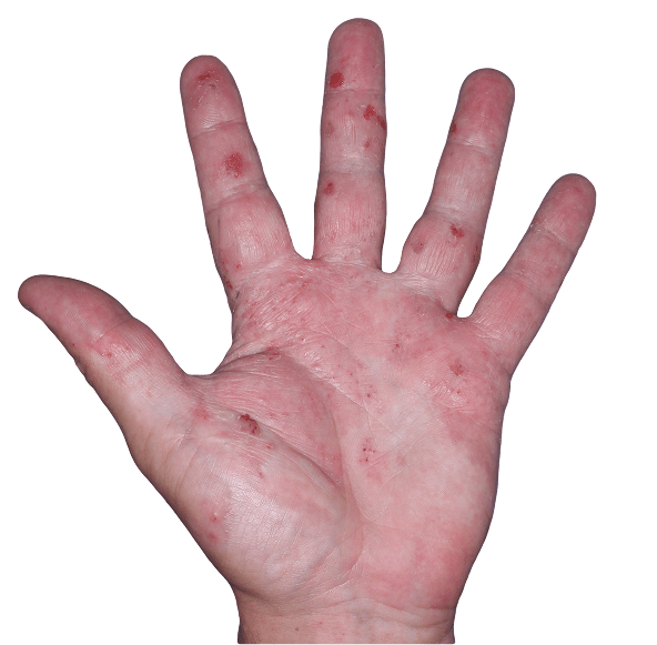 Case 3: At Baseline, patient has vesicles, erythema, and erosions. IGA-CHE score: 4. HESD-Itch score: 7.6. HESD-Pain score: 7.3.