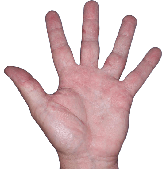 Case 3, Week 4: IGA-CHE score: 3. HESD-Itch score: 6.1. HESD-Pain score: 5.6