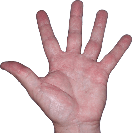 Case 3, Week 8: IGA-CHE score: 2. HESD-Itch score: 2. HESD-Pain score: 1.3