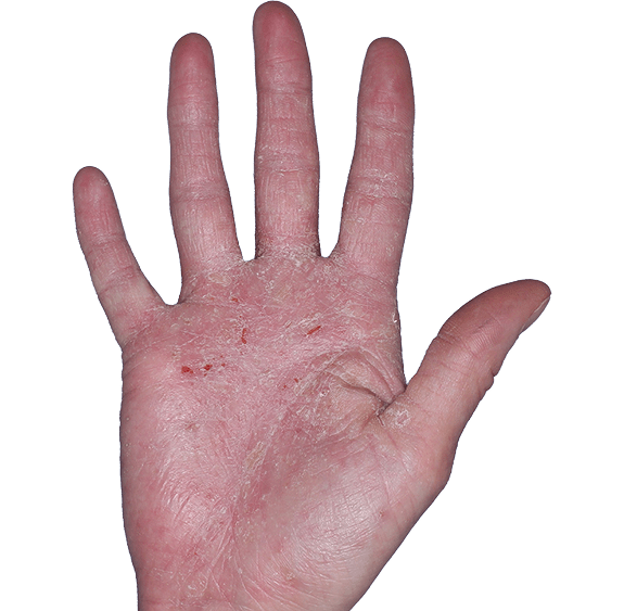 Case 4: At Baseline, patient has erythema, scaling, and eroisions. IGA-CHE score: 4. HESD-Itch score: 5.9. HESD-Pain score: 9