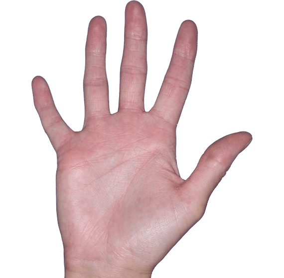 Case 4, Week 16: IGA-CHE score: 1. HESD-Itch score: 1.4. HESD-Pain score: 1.3