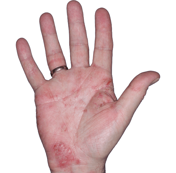 Case 5: At Baseline, patient has erythema, scaling, and fissure. IGA-CHE score: 3. HESD-Itch score: 6.1. HESD-Pain score: 6.3